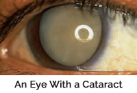 An eye with a cataract
