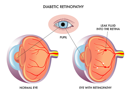 Diabetic Retinopathy