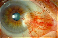 Pterygium